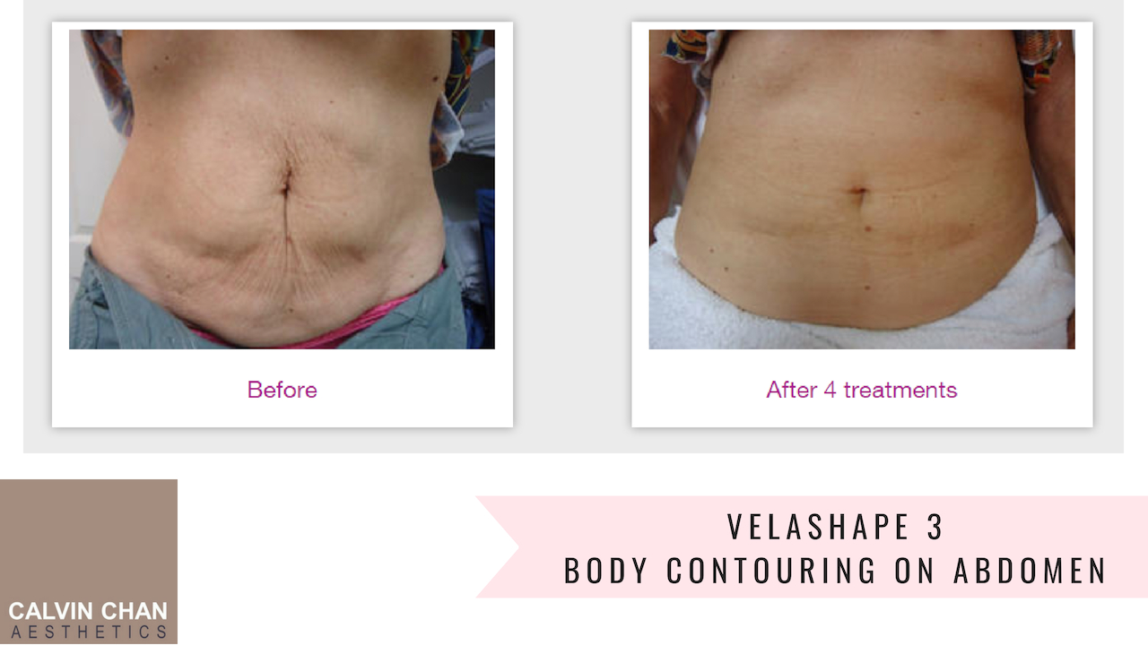 VelaShape 3 CALVIN CHAN AESTHETICS