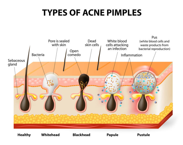 Acne Skin - CALVIN CHAN AESTHETICS