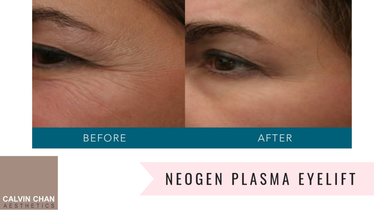 NeoGen Plasma Eyelift CALVIN CHAN AESTHETICS