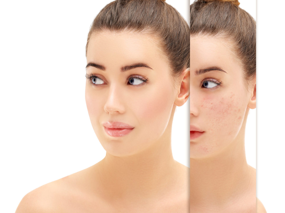 Don't Let Acne Rob You Of Your Self-Esteem