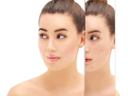 Don't Let Acne Rob You Of Your Self-Esteem