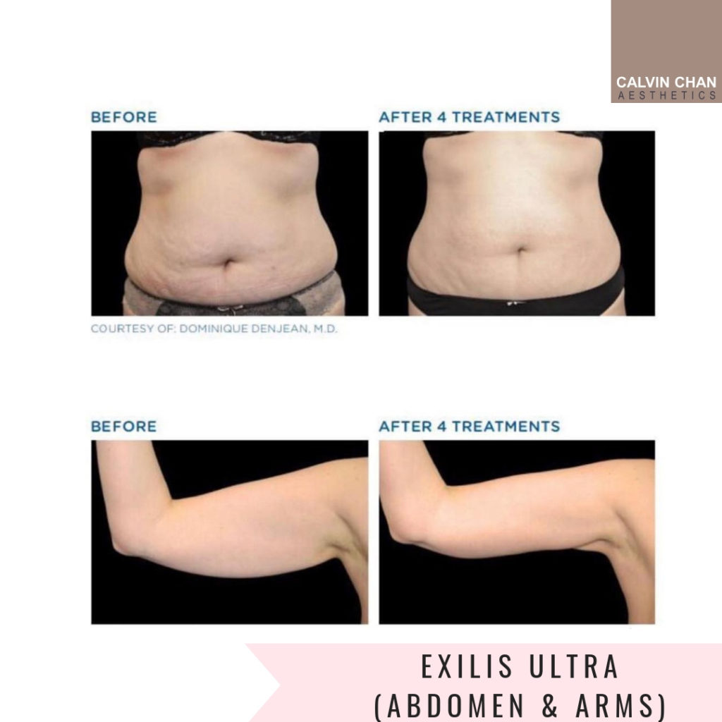 exilis body Offers online OFF60%