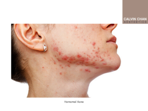treating hormonal acne