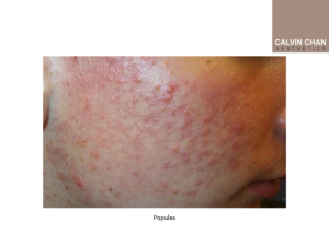 Papules pimples treatment