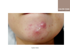 cystic acne