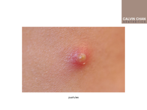 pustules pimples